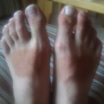 Efter en vecka i Gotland har Jonas fått ordentligt solbrända fötter.